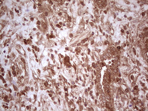 UBE2D2 / UBCH5B Antibody - IHC of paraffin-embedded Carcinoma of Human lung tissue using anti-UBE2D2 mouse monoclonal antibody. (Heat-induced epitope retrieval by 1 mM EDTA in 10mM Tris, pH8.5, 120°C for 3min).