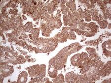 UBE2D2 / UBCH5B Antibody - IHC of paraffin-embedded Adenocarcinoma of Human ovary tissue using anti-UBE2D2 mouse monoclonal antibody. (Heat-induced epitope retrieval by 1 mM EDTA in 10mM Tris, pH8.5, 120°C for 3min).