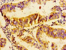 UBE2D2 / UBCH5B Antibody - Immunohistochemistry image of paraffin-embedded human endometrial cancer at a dilution of 1:100