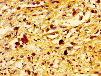 UBE2D2 / UBCH5B Antibody - Immunohistochemistry image of paraffin-embedded human melanoma cancer at a dilution of 1:100