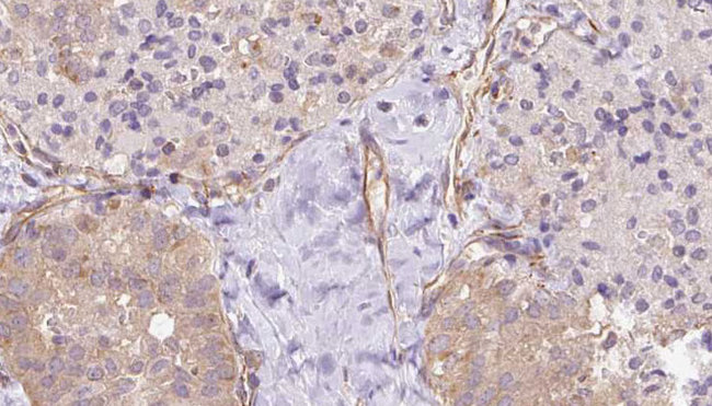 UBE2E2 / UBCH8 Antibody - 1:100 staining human thyroid carcinoma tissue by IHC-P. The sample was formaldehyde fixed and a heat mediated antigen retrieval step in citrate buffer was performed. The sample was then blocked and incubated with the antibody for 1.5 hours at 22°C. An HRP conjugated goat anti-rabbit antibody was used as the secondary.