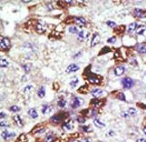UBE2E3 Antibody - Formalin-fixed and paraffin-embedded human cancer tissue reacted with the primary antibody, which was peroxidase-conjugated to the secondary antibody, followed by AEC staining. This data demonstrates the use of this antibody for immunohistochemistry; clinical relevance has not been evaluated. BC = breast carcinoma; HC = hepatocarcinoma.