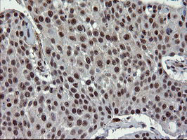 UBE2E3 Antibody - IHC of paraffin-embedded Carcinoma of Human lung tissue using anti-UBE2E3 mouse monoclonal antibody.