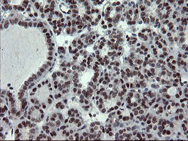 UBE2E3 Antibody - IHC of paraffin-embedded Carcinoma of Human thyroid tissue using anti-UBE2E3 mouse monoclonal antibody.