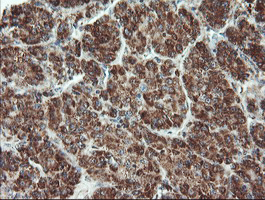 UBE2E3 Antibody - IHC of paraffin-embedded Carcinoma of Human liver tissue using anti-UBE2E3 mouse monoclonal antibody.