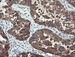 UBE2E3 Antibody - IHC of paraffin-embedded Adenocarcinoma of Human ovary tissue using anti-UBE2E3 mouse monoclonal antibody.