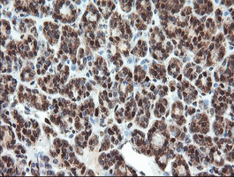 UBE2E3 Antibody - IHC of paraffin-embedded Carcinoma of Human thyroid tissue using anti-UBE2E3 mouse monoclonal antibody.