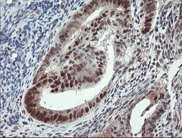 UBE2E3 Antibody - IHC of paraffin-embedded Adenocarcinoma of Human endometrium tissue using anti-UBE2E3 mouse monoclonal antibody.