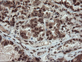 UBE2E3 Antibody - IHC of paraffin-embedded Adenocarcinoma of Human ovary tissue using anti-UBE2E3 mouse monoclonal antibody. (Heat-induced epitope retrieval by 10mM citric buffer, pH6.0, 100C for 10min).
