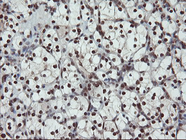 UBE2E3 Antibody - IHC of paraffin-embedded Carcinoma of Human kidney tissue using anti-UBE2E3 mouse monoclonal antibody. (Heat-induced epitope retrieval by 10mM citric buffer, pH6.0, 100C for 10min).