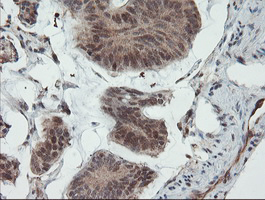 UBE2E3 Antibody - IHC of paraffin-embedded Carcinoma of Human pancreas tissue using anti-UBE2E3 mouse monoclonal antibody. (Heat-induced epitope retrieval by 10mM citric buffer, pH6.0, 100C for 10min).