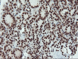 UBE2E3 Antibody - IHC of paraffin-embedded Carcinoma of Human thyroid tissue using anti-UBE2E3 mouse monoclonal antibody. (Heat-induced epitope retrieval by 10mM citric buffer, pH6.0, 100C for 10min).