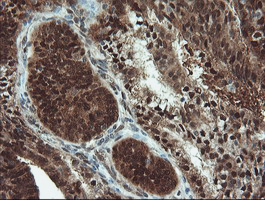 UBE2E3 Antibody - IHC of paraffin-embedded Adenocarcinoma of Human endometrium tissue using anti-UBE2E3 mouse monoclonal antibody. (Heat-induced epitope retrieval by 10mM citric buffer, pH6.0, 100C for 10min).