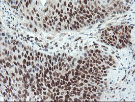 UBE2E3 Antibody - IHC of paraffin-embedded Carcinoma of Human bladder tissue using anti-UBE2E3 mouse monoclonal antibody. (Heat-induced epitope retrieval by 10mM citric buffer, pH6.0, 100C for 10min).