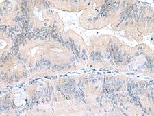 UBE2F Antibody - Immunohistochemistry of paraffin-embedded Human colorectal cancer tissue  using UBE2F Polyclonal Antibody at dilution of 1:70(×200)