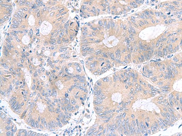 UBE2F Antibody - Immunohistochemistry of paraffin-embedded Human colorectal cancer tissue  using UBE2F Polyclonal Antibody at dilution of 1:100(×200)