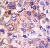 UBE2G1 Antibody - Formalin-fixed and paraffin-embedded human cancer tissue reacted with the primary antibody, which was peroxidase-conjugated to the secondary antibody, followed by DAB staining. This data demonstrates the use of this antibody for immunohistochemistry; clinical relevance has not been evaluated. BC = breast carcinoma; HC = hepatocarcinoma.