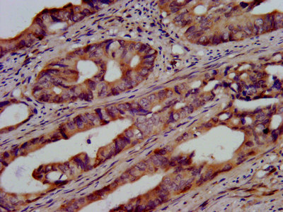 UBE2G1 Antibody - Immunohistochemistry image at a dilution of 1:500 and staining in paraffin-embedded human colon cancer performed on a Leica BondTM system. After dewaxing and hydration, antigen retrieval was mediated by high pressure in a citrate buffer (pH 6.0) . Section was blocked with 10% normal goat serum 30min at RT. Then primary antibody (1% BSA) was incubated at 4 °C overnight. The primary is detected by a biotinylated secondary antibody and visualized using an HRP conjugated SP system.