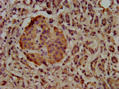 UBE2G1 Antibody - Immunohistochemistry image at a dilution of 1:500 and staining in paraffin-embedded human pancreatic cancer performed on a Leica BondTM system. After dewaxing and hydration, antigen retrieval was mediated by high pressure in a citrate buffer (pH 6.0) . Section was blocked with 10% normal goat serum 30min at RT. Then primary antibody (1% BSA) was incubated at 4 °C overnight. The primary is detected by a biotinylated secondary antibody and visualized using an HRP conjugated SP system.