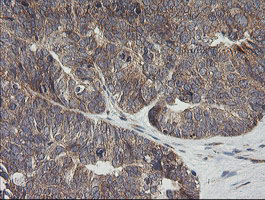 UBE2G2 Antibody - IHC of paraffin-embedded Adenocarcinoma of Human ovary tissue using anti-UBE2G2 mouse monoclonal antibody. (Heat-induced epitope retrieval by 10mM citric buffer, pH6.0, 120°C for 3min).