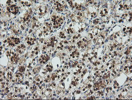 UBE2G2 Antibody - IHC of paraffin-embedded Carcinoma of Human kidney tissue using anti-UBE2G2 mouse monoclonal antibody. (Heat-induced epitope retrieval by 10mM citric buffer, pH6.0, 120°C for 3min).