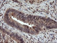 UBE2G2 Antibody - IHC of paraffin-embedded Adenocarcinoma of Human colon tissue using anti-UBE2G2 mouse monoclonal antibody.