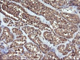 UBE2G2 Antibody - IHC of paraffin-embedded Carcinoma of Human thyroid tissue using anti-UBE2G2 mouse monoclonal antibody.