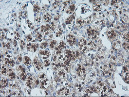 UBE2G2 Antibody - IHC of paraffin-embedded Carcinoma of Human kidney tissue using anti-UBE2G2 mouse monoclonal antibody.