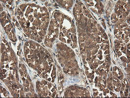 UBE2G2 Antibody - IHC of paraffin-embedded Carcinoma of Human thyroid tissue using anti-UBE2G2 mouse monoclonal antibody.