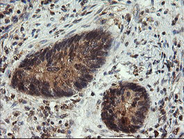 UBE2G2 Antibody - IHC of paraffin-embedded Adenocarcinoma of Human colon tissue using anti-UBE2G2 mouse monoclonal antibody. (Heat-induced epitope retrieval by 10mM citric buffer, pH6.0, 120°C for 3min).