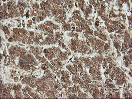 UBE2G2 Antibody - IHC of paraffin-embedded Carcinoma of Human liver tissue using anti-UBE2G2 mouse monoclonal antibody.