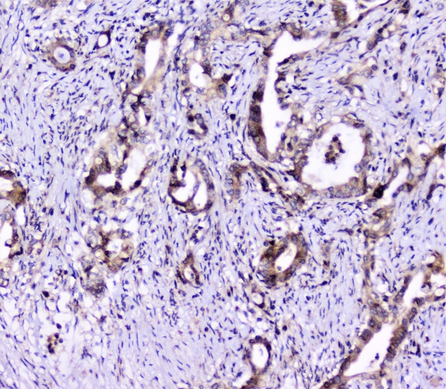 UBE2I / UBC9 Antibody - IHC analysis of UBE2I/UBC9 using anti-UBE2I/UBC9 antibody. UBE2I/UBC9 was detected in paraffin-embedded section of human rectal cancer tissue. Heat mediated antigen retrieval was performed in citrate buffer (pH6, epitope retrieval solution) for 20 mins. The tissue section was blocked with 10% goat serum. The tissue section was then incubated with 1µg/ml rabbit anti-UBE2I/UBC9 Antibody overnight at 4°C. Biotinylated goat anti-rabbit IgG was used as secondary antibody and incubated for 30 minutes at 37°C. The tissue section was developed using Strepavidin-Biotin-Complex (SABC) with DAB as the chromogen.