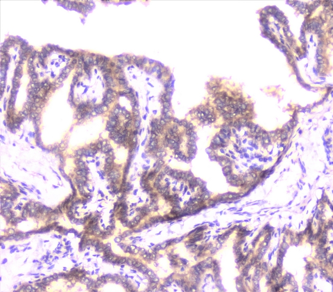UBE2I / UBC9 Antibody - IHC analysis of UBE2I/UBC9 using anti-UBE2I/UBC9 antibody. UBE2I/UBC9 was detected in paraffin-embedded section of human thyroid cancer tissue. Heat mediated antigen retrieval was performed in citrate buffer (pH6, epitope retrieval solution) for 20 mins. The tissue section was blocked with 10% goat serum. The tissue section was then incubated with 1µg/ml rabbit anti-UBE2I/UBC9 Antibody overnight at 4°C. Biotinylated goat anti-rabbit IgG was used as secondary antibody and incubated for 30 minutes at 37°C. The tissue section was developed using Strepavidin-Biotin-Complex (SABC) with DAB as the chromogen.