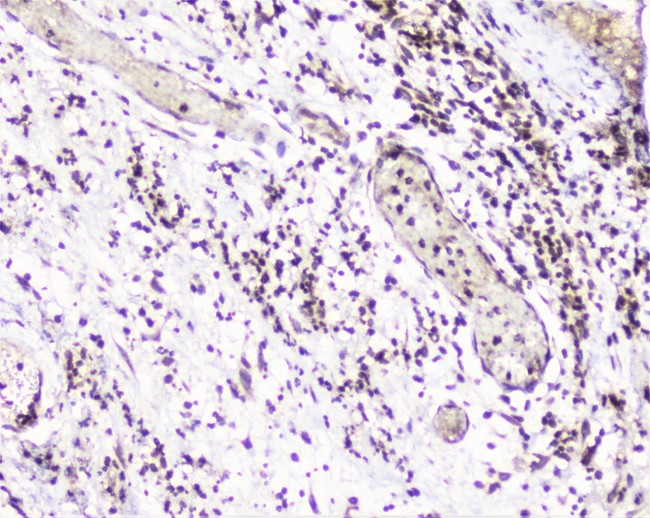 UBE2I / UBC9 Antibody - IHC analysis of UBE2I UBC9 using anti-UBE2I UBC9 antibody. UBE2I UBC9 was detected in paraffin-embedded section of human appendicitis tissue. Heat mediated antigen retrieval was performed in citrate buffer (pH6, epitope retrieval solution) for 20 mins. The tissue section was blocked with 10% goat serum. The tissue section was then incubated with 1µg/ml rabbit anti-UBE2I UBC9 Antibody overnight at 4°C. Biotinylated goat anti-rabbit IgG was used as secondary antibody and incubated for 30 minutes at 37°C. The tissue section was developed using Strepavidin-Biotin-Complex (SABC) with DAB as the chromogen.