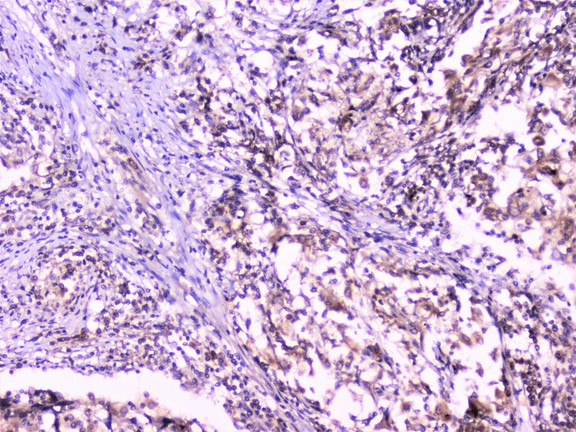 UBE2I / UBC9 Antibody - IHC analysis of UBE2I UBC9 using anti-UBE2I UBC9 antibody. UBE2I UBC9 was detected in paraffin-embedded section of human lung cancer tissue. Heat mediated antigen retrieval was performed in citrate buffer (pH6, epitope retrieval solution) for 20 mins. The tissue section was blocked with 10% goat serum. The tissue section was then incubated with 1µg/ml rabbit anti-UBE2I UBC9 Antibody overnight at 4°C. Biotinylated goat anti-rabbit IgG was used as secondary antibody and incubated for 30 minutes at 37°C. The tissue section was developed using Strepavidin-Biotin-Complex (SABC) with DAB as the chromogen.