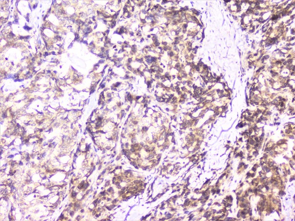 UBE2I / UBC9 Antibody - IHC analysis of UBE2I UBC9 using anti-UBE2I UBC9 antibody. UBE2I UBC9 was detected in paraffin-embedded section of human gastric cancer tissue. Heat mediated antigen retrieval was performed in citrate buffer (pH6, epitope retrieval solution) for 20 mins. The tissue section was blocked with 10% goat serum. The tissue section was then incubated with 1µg/ml rabbit anti-UBE2I UBC9 Antibody overnight at 4°C. Biotinylated goat anti-rabbit IgG was used as secondary antibody and incubated for 30 minutes at 37°C. The tissue section was developed using Strepavidin-Biotin-Complex (SABC) with DAB as the chromogen.
