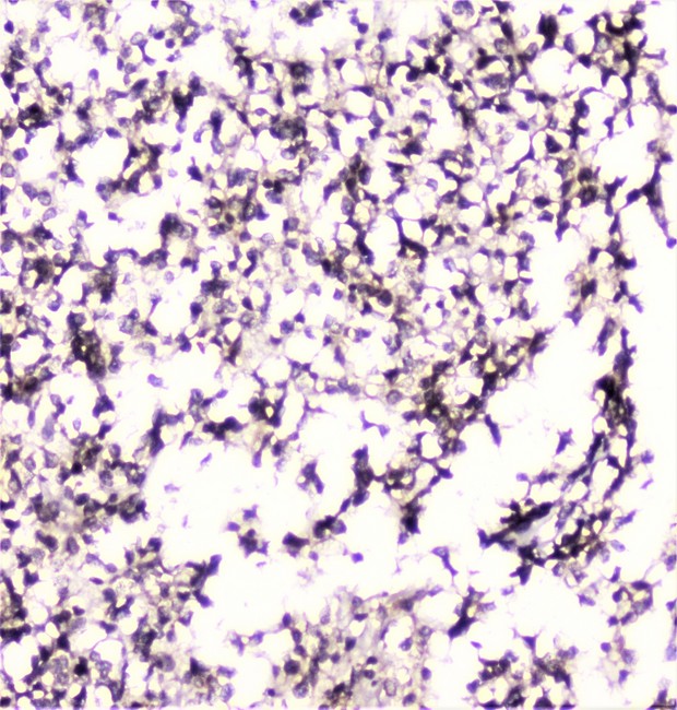 UBE2I / UBC9 Antibody - IHC analysis of UBE2I UBC9 using anti-UBE2I UBC9 antibody. UBE2I UBC9 was detected in paraffin-embedded section of human glioma tissue. Heat mediated antigen retrieval was performed in citrate buffer (pH6, epitope retrieval solution) for 20 mins. The tissue section was blocked with 10% goat serum. The tissue section was then incubated with 1µg/ml rabbit anti-UBE2I UBC9 Antibody overnight at 4°C. Biotinylated goat anti-rabbit IgG was used as secondary antibody and incubated for 30 minutes at 37°C. The tissue section was developed using Strepavidin-Biotin-Complex (SABC) with DAB as the chromogen.