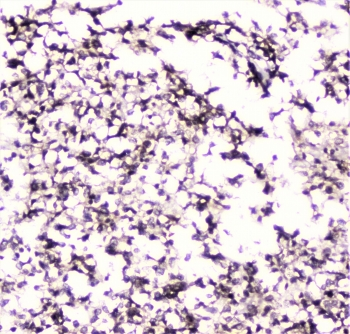 UBE2I / UBC9 Antibody - IHC staining of FFPE human glioma with UBC9 antibody at 1ug/ml. HIER: boil tissue sections in pH6, 10mM citrate buffer, for 10-20 min followed by cooling at RT for 20 min.