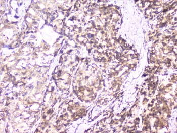 UBE2I / UBC9 Antibody - IHC staining of FFPE human stomach cancer with UBC9 antibody at 1ug/ml. HIER: boil tissue sections in pH6, 10mM citrate buffer, for 10-20 min followed by cooling at RT for 20 min.