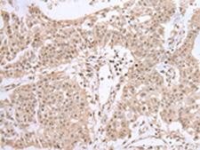 UBE2I / UBC9 Antibody - Immunohistochemistry of paraffin-embedded Human colorectal cancer tissue  using UBE2I Polyclonal Antibody at dilution of 1:40(×200)