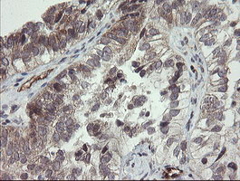 UBE2J1 Antibody - IHC of paraffin-embedded Adenocarcinoma of Human ovary tissue using anti-UBE2J1 mouse monoclonal antibody.