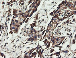 UBE2J1 Antibody - IHC of paraffin-embedded Adenocarcinoma of Human breast tissue using anti-UBE2J1 mouse monoclonal antibody.