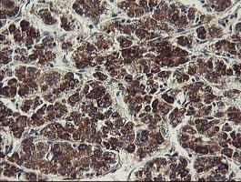 UBE2J1 Antibody - IHC of paraffin-embedded Carcinoma of Human liver tissue using anti-UBE2J1 mouse monoclonal antibody.