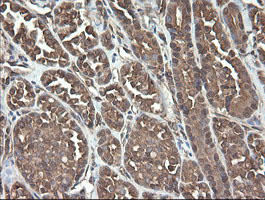 UBE2J1 Antibody - IHC of paraffin-embedded Carcinoma of Human thyroid tissue using anti-UBE2J1 mouse monoclonal antibody.