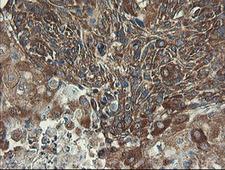 UBE2J1 Antibody - IHC of paraffin-embedded Carcinoma of Human lung tissue using anti-UBE2J1 mouse monoclonal antibody.