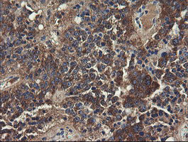 UBE2J1 Antibody - IHC of paraffin-embedded Carcinoma of Human pancreas tissue using anti-UBE2J1 mouse monoclonal antibody.