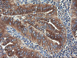 UBE2J1 Antibody - IHC of paraffin-embedded Adenocarcinoma of Human endometrium tissue using anti-UBE2J1 mouse monoclonal antibody.