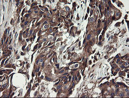 UBE2J1 Antibody - IHC of paraffin-embedded Adenocarcinoma of Human breast tissue using anti-UBE2J1 mouse monoclonal antibody.