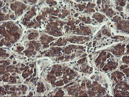 UBE2J1 Antibody - IHC of paraffin-embedded Carcinoma of Human liver tissue using anti-UBE2J1 mouse monoclonal antibody.
