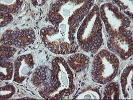 UBE2J1 Antibody - IHC of paraffin-embedded Carcinoma of Human prostate tissue using anti-UBE2J1 mouse monoclonal antibody.